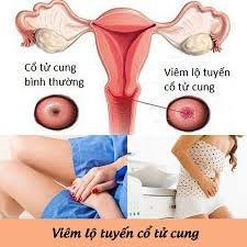 Dấu hiệu viêm lộ tuyến cổ tử cung cần biết