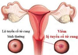Tác hại bệnh viêm lộ tuyến cổ tử cung phái đẹp cần biết để có biện pháp phòng  tránh