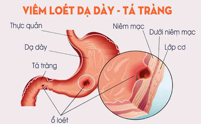Viêm loét dạ dày