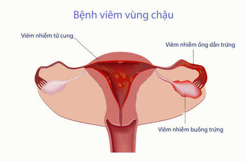 Viêm vùng chậu