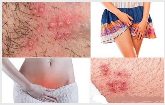 Nổi mụn ở bộ phận sinh dục nữ là bệnh gì? 5 cách khắc phục