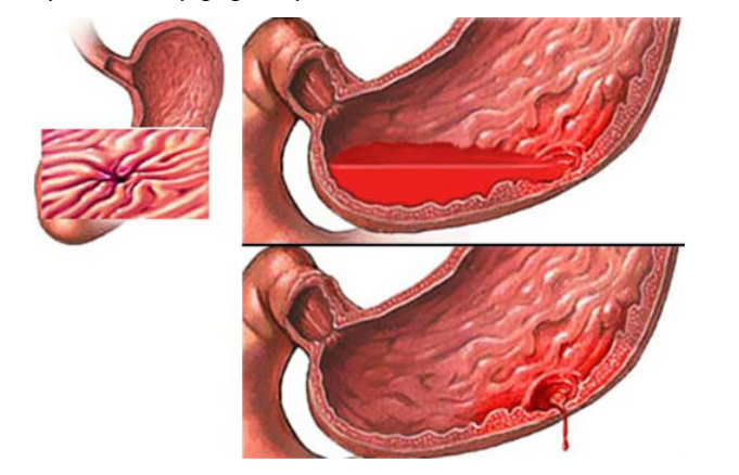 Xuất huyết tiêu hóa trên