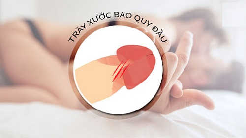 Xước da bao quy đầu